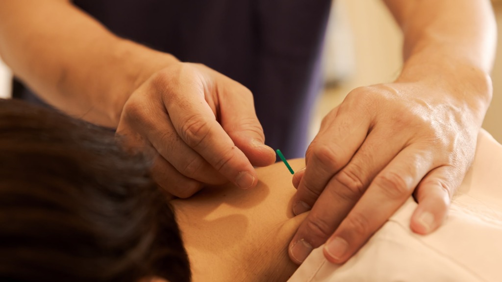 肩こりへの鍼治療