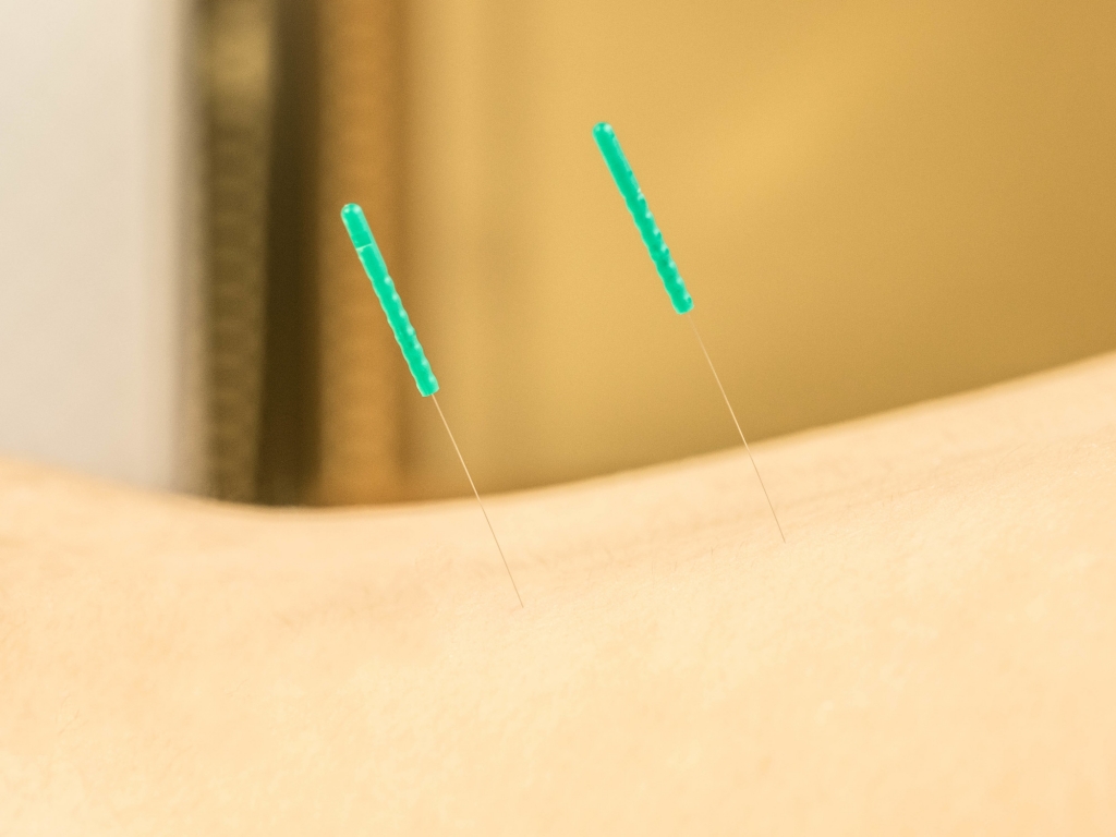 鍼治療｜Kanamori鍼灸院