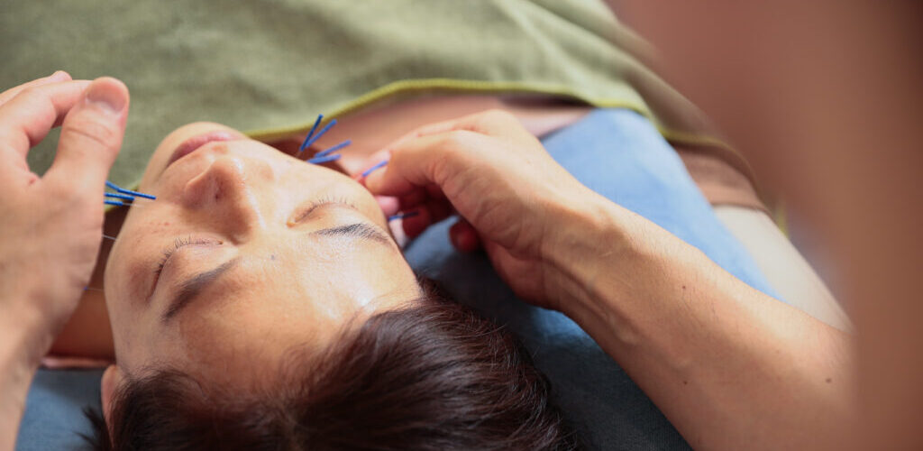 美容鍼の施術風景｜Kanamori鍼灸院