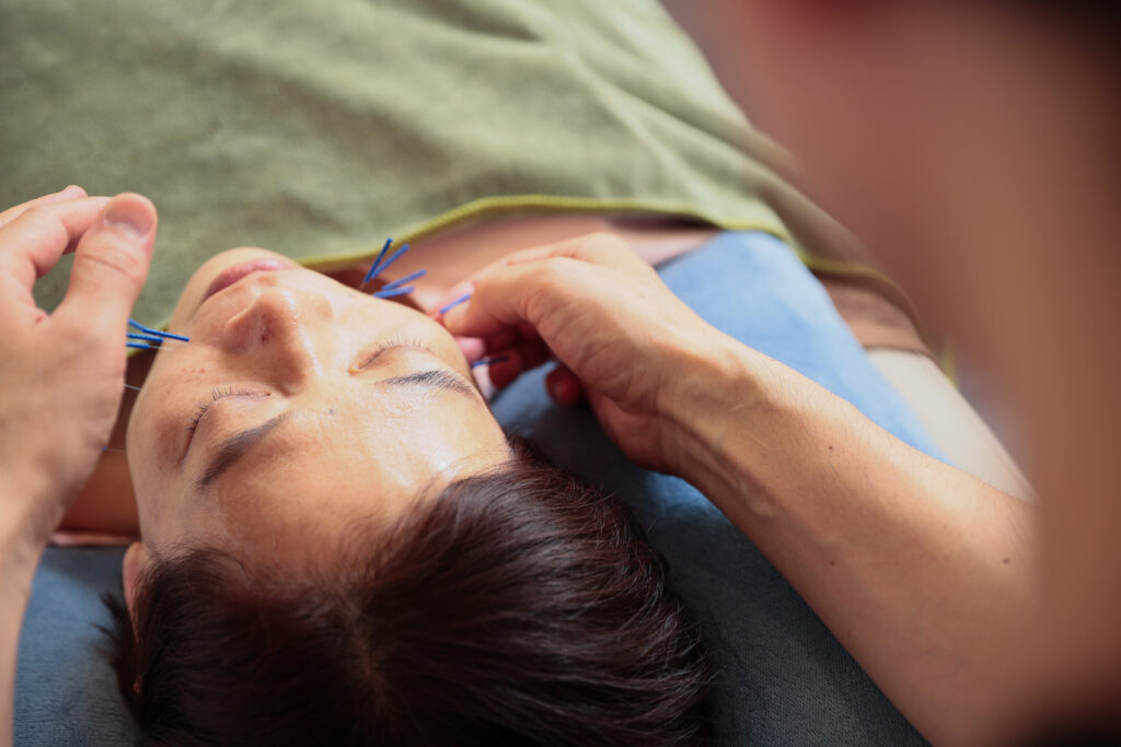 自律神経調整の顔・頭への鍼治療
