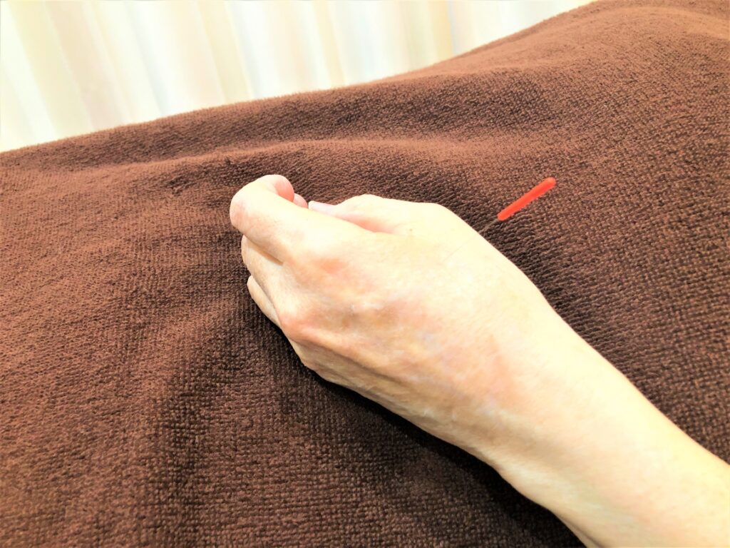 合谷への鍼|Kanamori鍼灸院