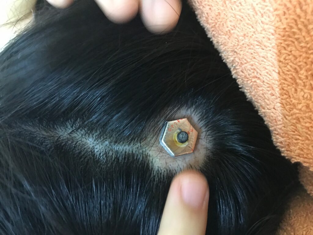 円形脱毛症への鍼灸